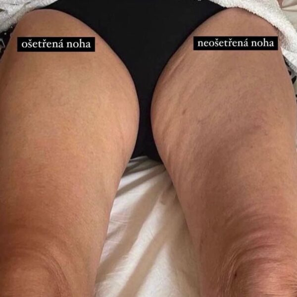 WellSpa iO před a po