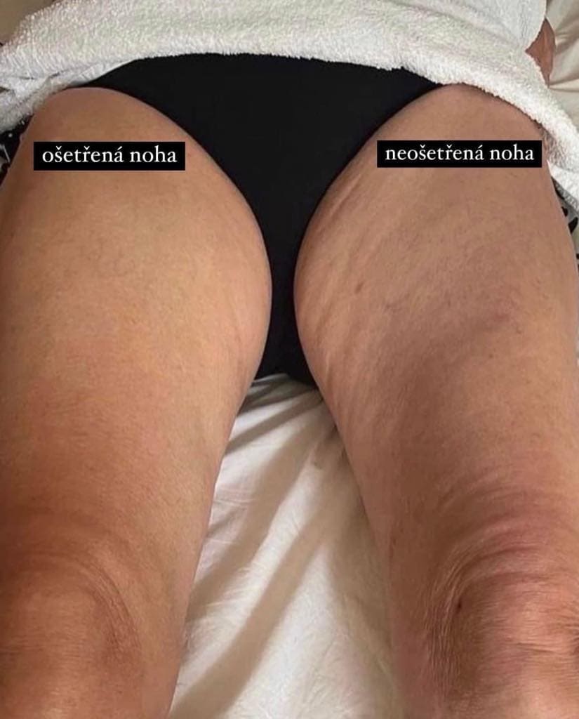 WellSpa iO před a po